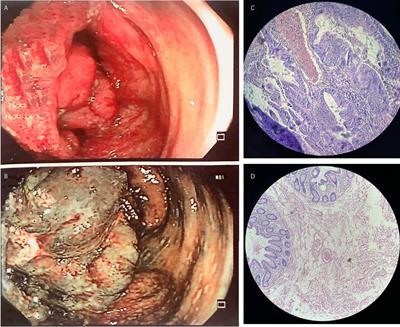 Case report: Exploring Lynch Syndrome through genomic analysis in a mestizo Ecuadorian patient and his brother